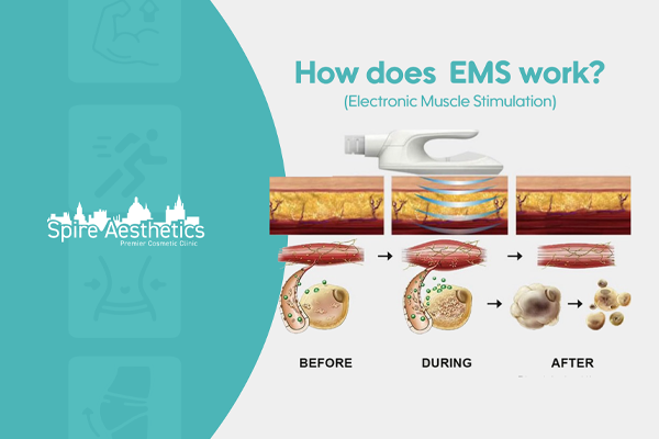 EMS treatment for post pregnancy weight loss treatment Sandy