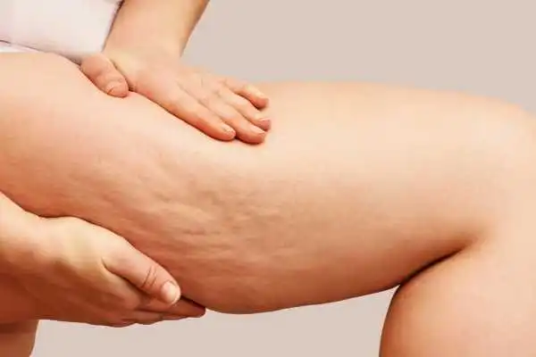 Image of woman showing leg with cellulite Sandy