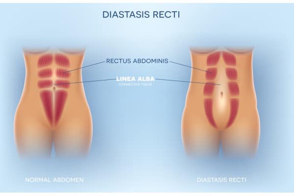 What Non-Surgical Options Are Available for Diastasis Recti Sandy?