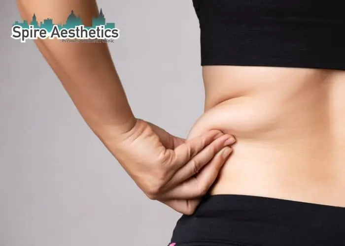 Image of woman pinching fat on their hips Sandy. Fat Freezing treatment