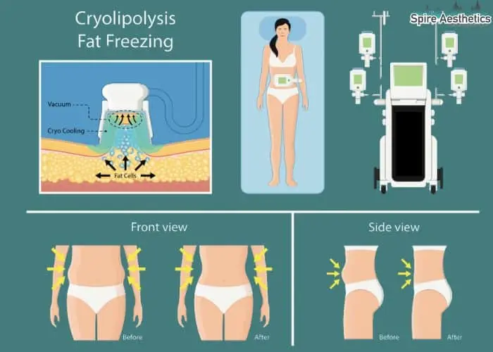 Fat freezing treatment Sandy benefits for competitions to remove stubborn fat deposits.