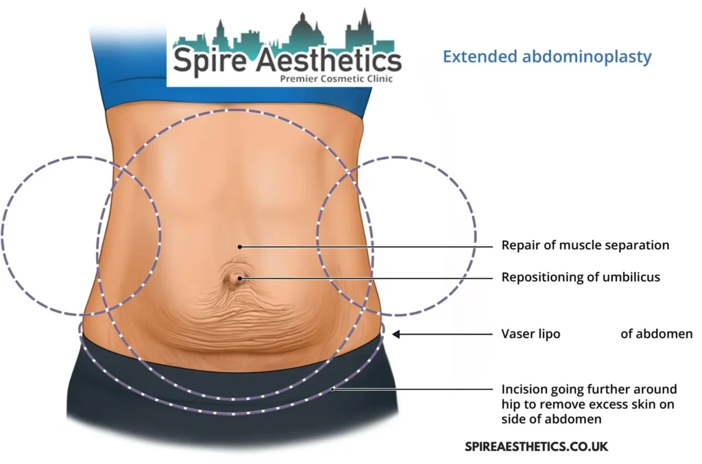 Understanding Loose Skin After Gastric Band Sandy Surgery and HIFU Treatment