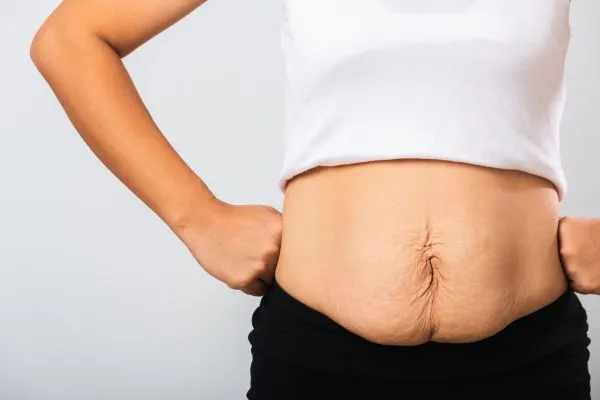 Image of a woman's stomach after weight loss with sagging skin following a gastric band Sandy