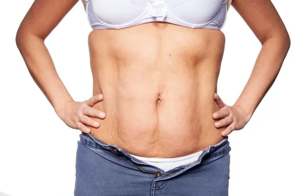 sagging skin on woman's stomach after weight loss injections Sandy
