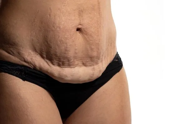 Image of womans stomach after weight loss injections Sandy showing saggy skin