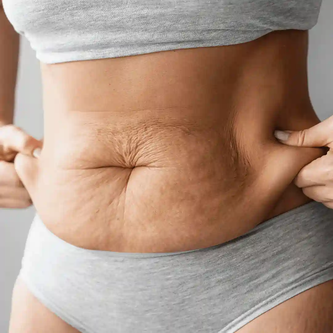 Is It Normal to Have Loose Skin After Pregnancy Sandy?