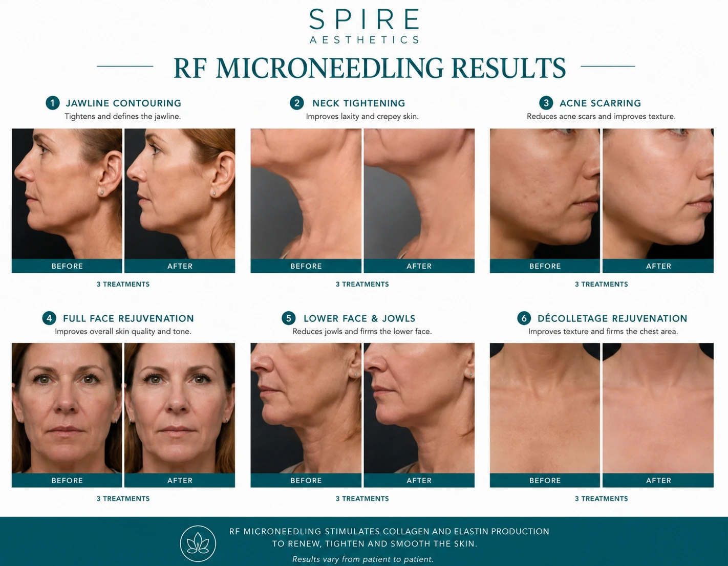 RF Microneedling Skin tightening Sandy results