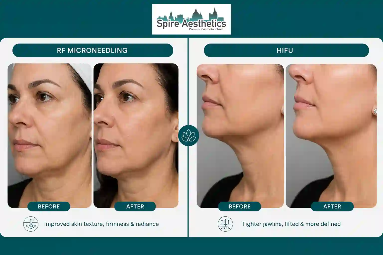Can RF Microneedling and HIFU Be Combined Sandy?