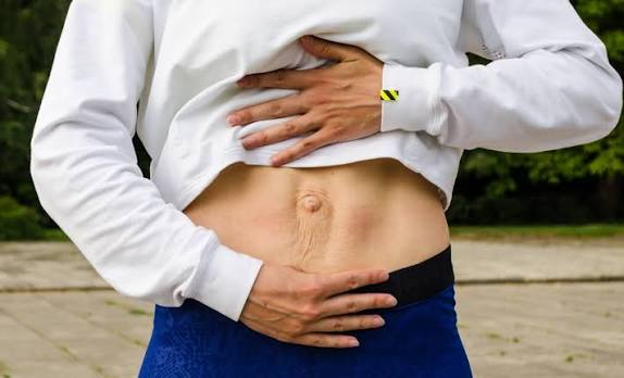 When Could Diastasis Recti Be the Missing Piece of the Puzzle Sandy?