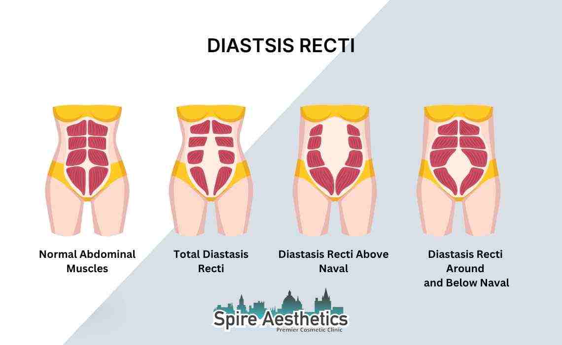 Is Non-Surgical Diastasis Recti Treatment Right for You? Common Concerns Answered Sandy
